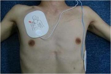 電極パッドを取り付けられた上半身の写真